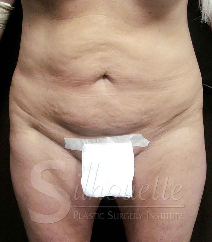Tummy Tuck before and after - before