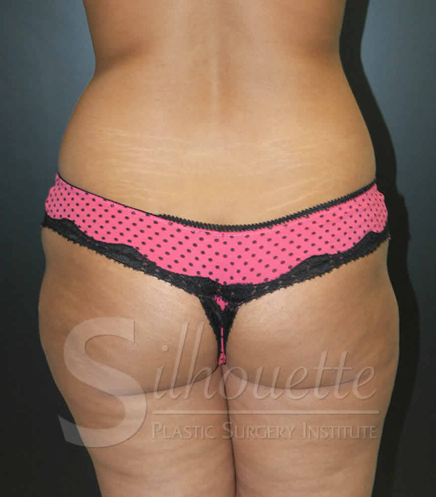 Liposuction before and after - before