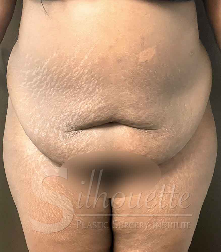 Tummy Tuck before and after - before