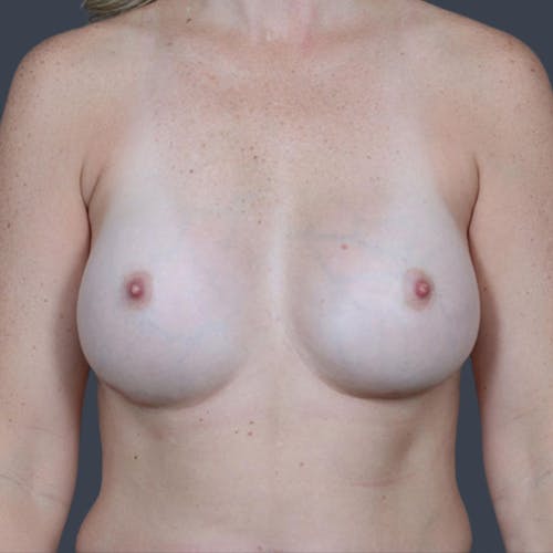 Breast Augmentation before and after - after