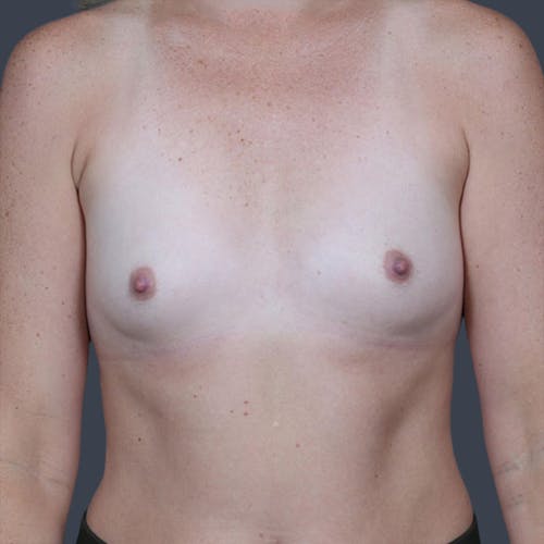 Breast Augmentation before and after - before