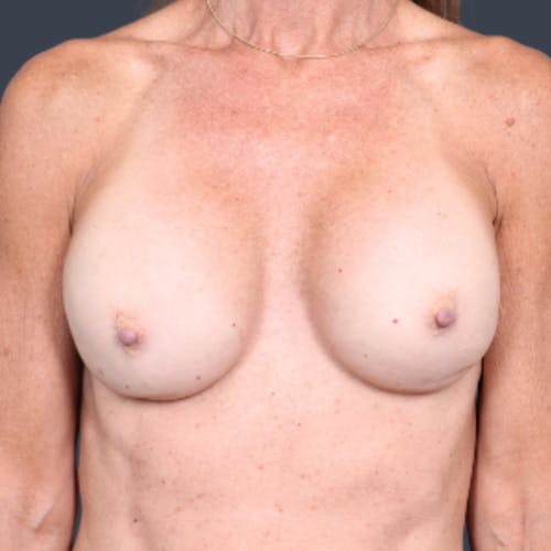 Breast Augmentation before and after - before