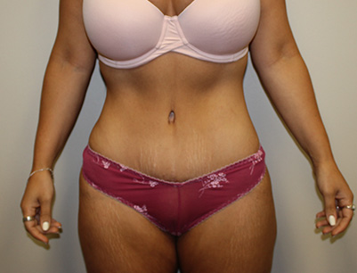 Tummy Tuck before and after - after