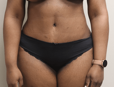 Tummy Tuck before and after - after