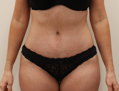Tummy Tuck before and after - after