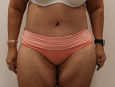 Tummy Tuck before and after - after