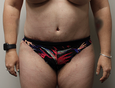 Tummy Tuck before and after - after