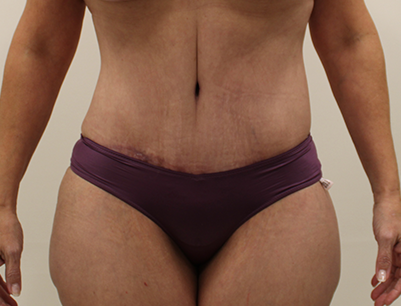 Tummy Tuck before and after - after