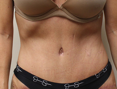 Tummy Tuck before and after - after