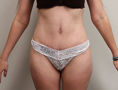 Tummy Tuck before and after - after