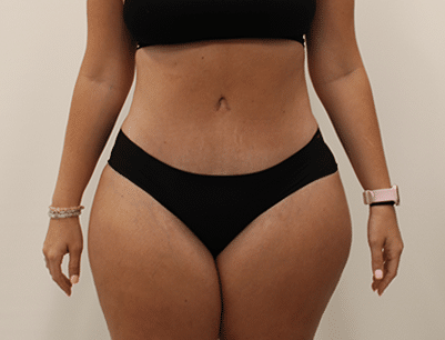 Tummy Tuck before and after - after