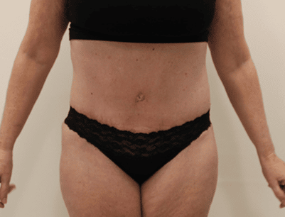 Tummy Tuck before and after - after