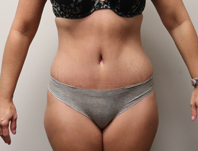 Tummy Tuck before and after - after