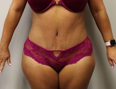 Tummy Tuck before and after - after