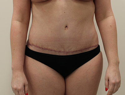 Tummy Tuck before and after - after