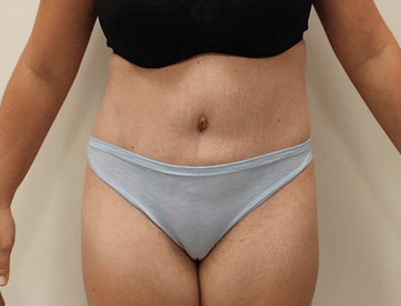 Tummy Tuck before and after - after