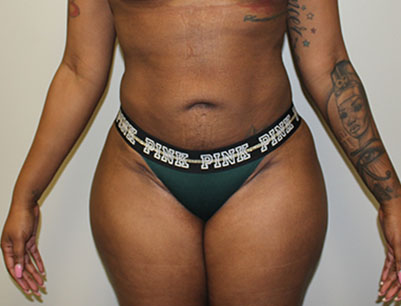 Liposuction before and after - after