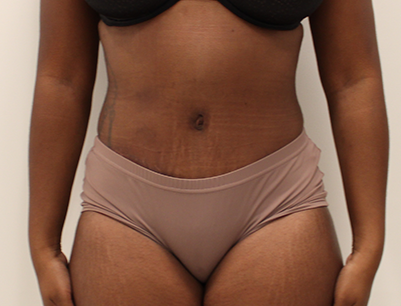 Tummy Tuck before and after - after