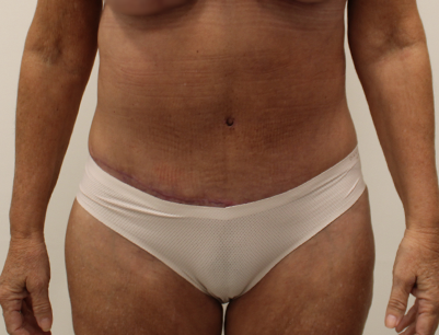 Tummy Tuck before and after - after