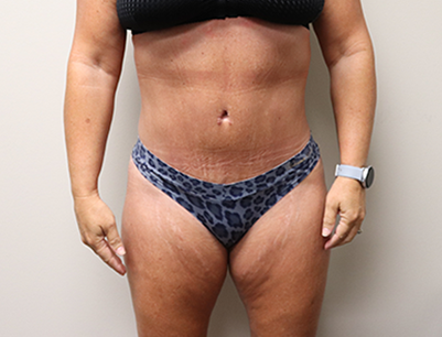 Tummy Tuck before and after - after