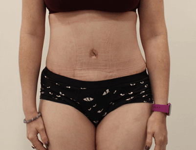 Tummy Tuck before and after - after