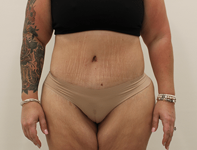 Tummy Tuck before and after - after