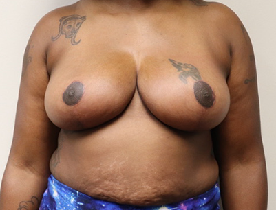 Breast Lift before and after - after