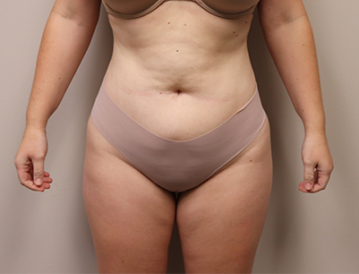 Liposuction before and after - after
