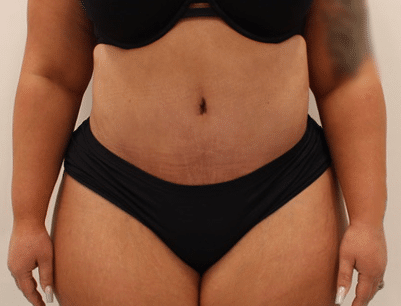 Tummy Tuck before and after - after