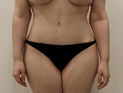 Tummy Tuck before and after - after