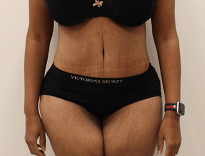 Tummy Tuck before and after - after