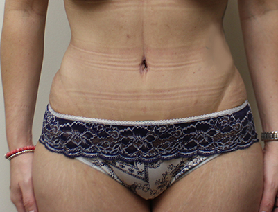 Tummy Tuck before and after - after