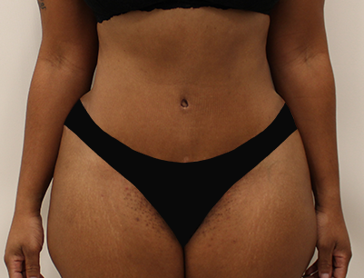 Tummy Tuck before and after - after