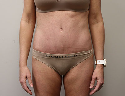 Tummy Tuck before and after - after