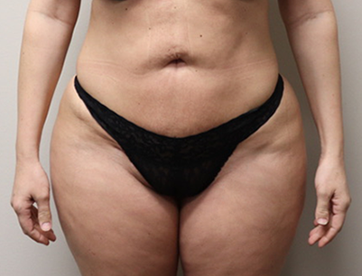 Liposuction before and after - after