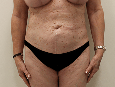 Liposuction before and after - after