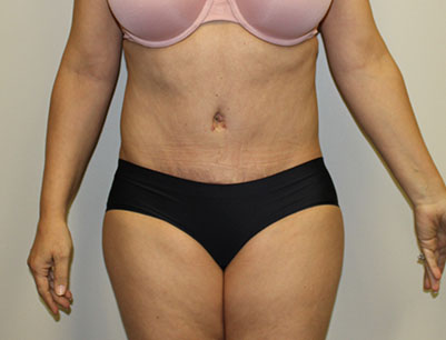 Tummy Tuck before and after - after