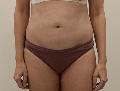 Liposuction before and after - after