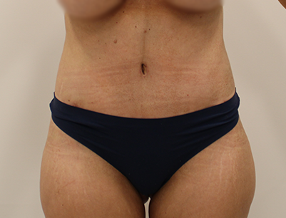 Tummy Tuck before and after - after