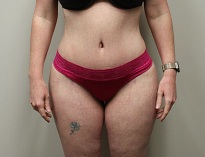 Tummy Tuck before and after - after