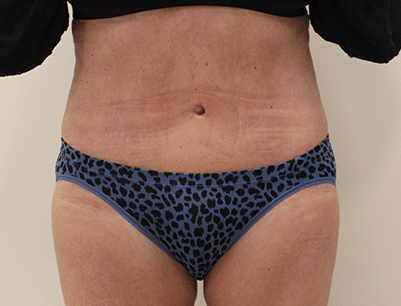 Tummy Tuck before and after - after