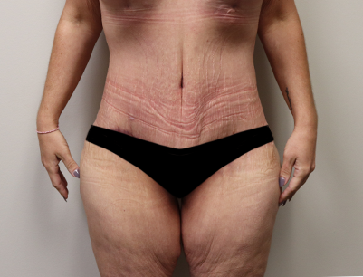 Tummy Tuck before and after - after