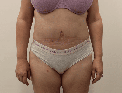 Tummy Tuck before and after - after
