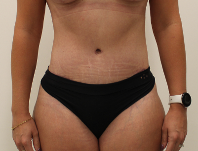 Tummy Tuck before and after - after