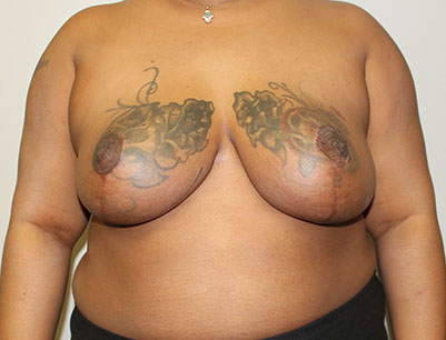 Breast Reduction before and after - after