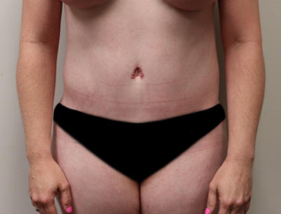 Tummy Tuck before and after - after