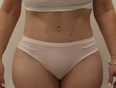 Tummy Tuck before and after - after