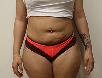 Liposuction before and after - after