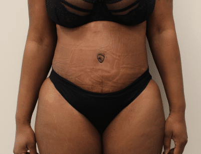 Tummy Tuck before and after - after
