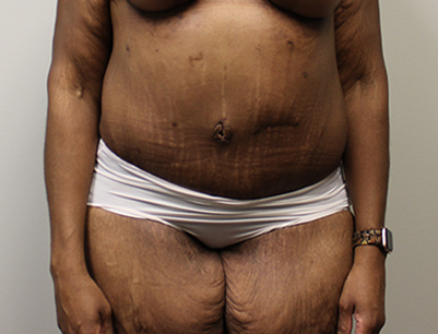 Tummy Tuck before and after - after